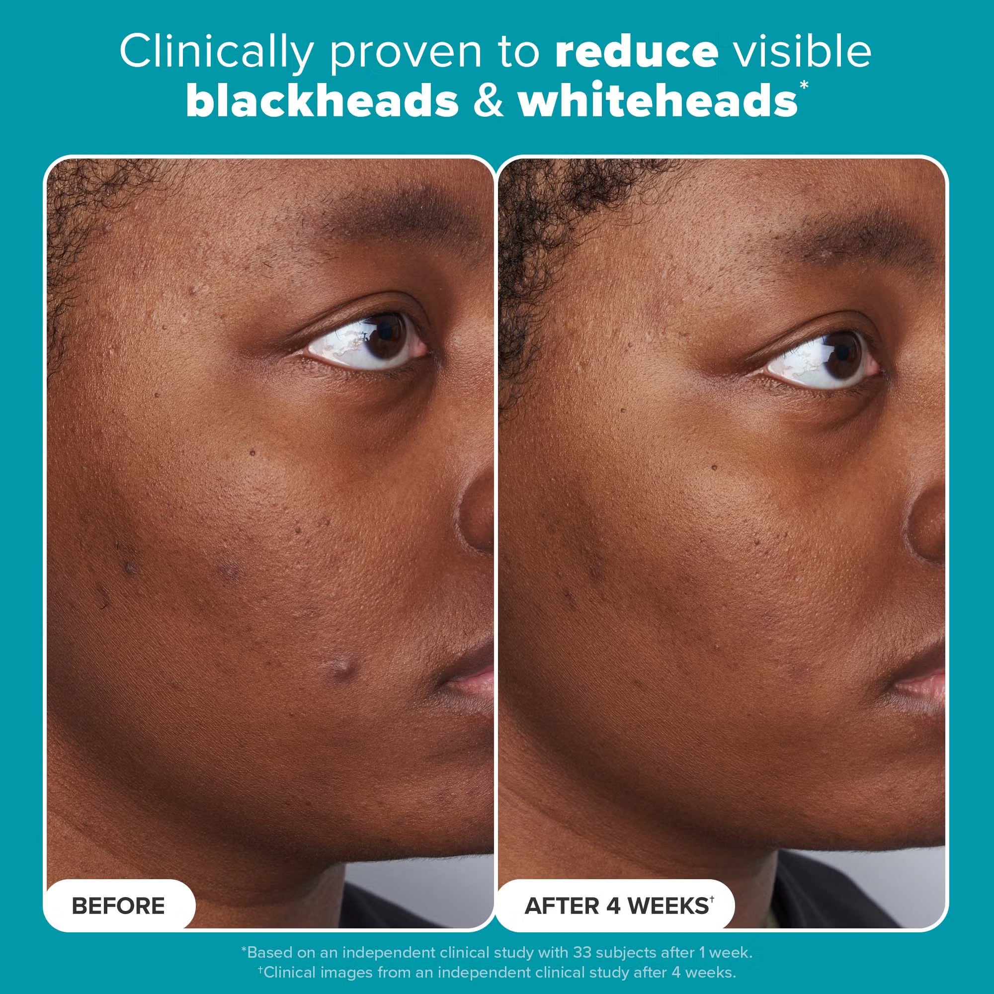 Paula’s Choice Skin Perfecting 2% BHA Liquid Exfoliant 30ml